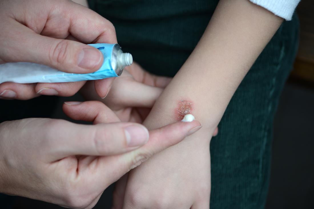 کاربرد میکرونیدلینگ جهت درمان اسکار سوختگی در کودکان